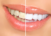 cosmetic dentistry teeth whitening before and after results Upland, CA