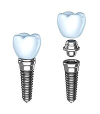 graphic of dental implant assembly Upland, CA 