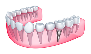 graphic illustration of set of teeth with dental implants Upland, CA